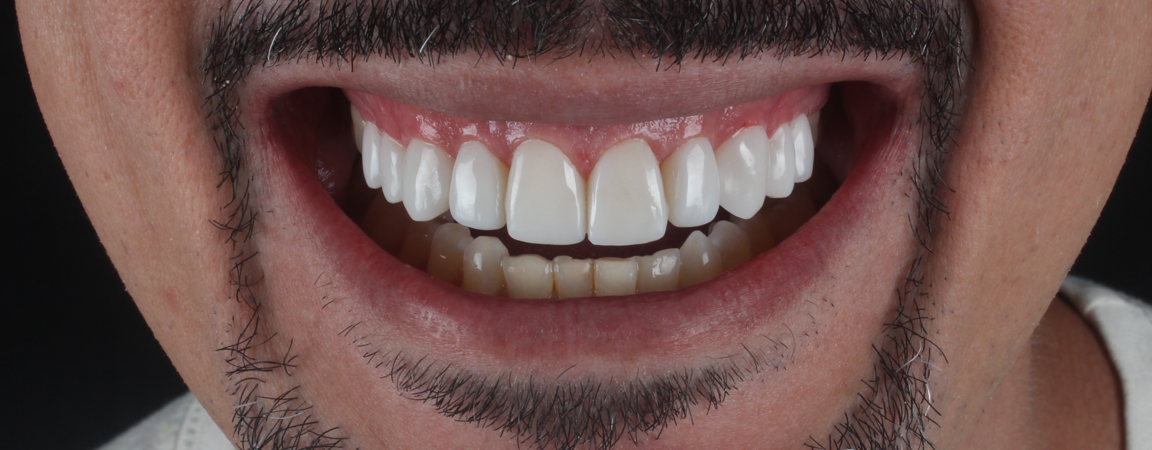 Depois das facetas de resina